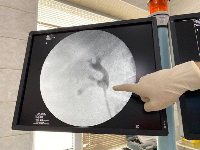 Волинські медики видалили пенсіонерці величезний камінь з нирки