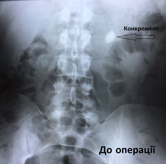 У волинській лікарні пацієнту видалили чималий камінь з нирки без розрізів