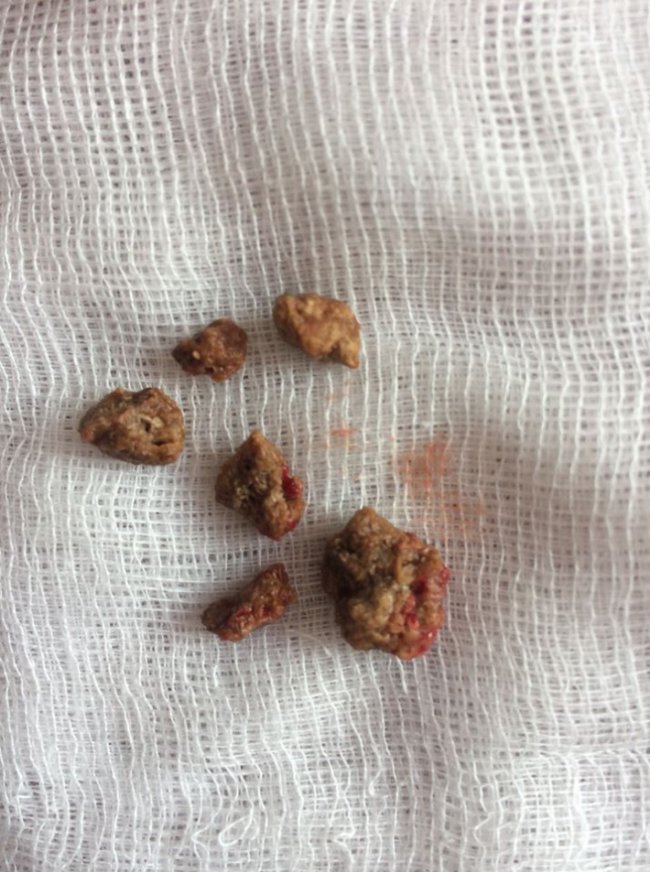 У волинській лікарні пацієнту видалили чималий камінь з нирки без розрізів