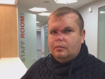 Лікар Валіхновський відновив носа атовцю