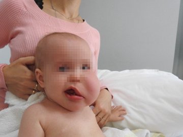 Хірург з Волині видалив з обличчя немовляти величезну пухлину. ФОТО