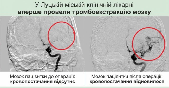 У Луцьку вперше видалили тромб з мозкової артерії. ФОТО