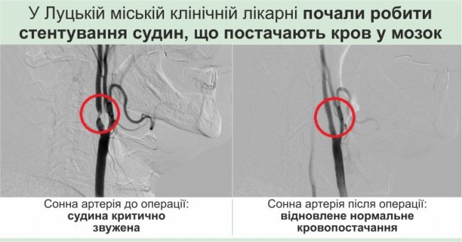 У Луцьку вперше видалили тромб з мозкової артерії. ФОТО