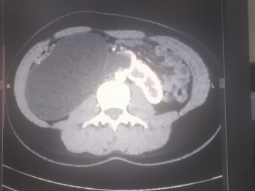 Волинські медики провели унікальну операцію 17-річній дівчині, в якої зрослися нирки