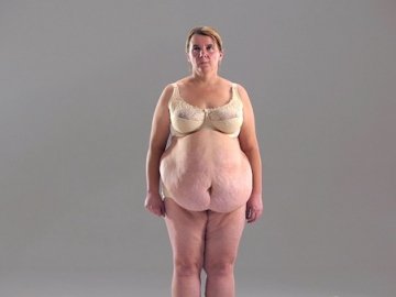 На проекті «Поверніть мені красу» волинянці вирізали 13 кілограмів шкіри