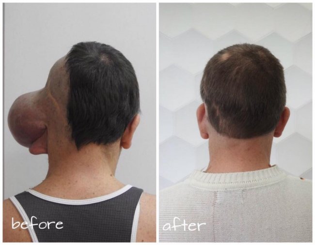 Рік потому: відомий хірург з Волині видалив з голови чоловіка велетенську пухлину