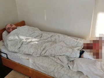 Випив і заснув на лавці на Новий рік: лучанин відморозив обидві стопи