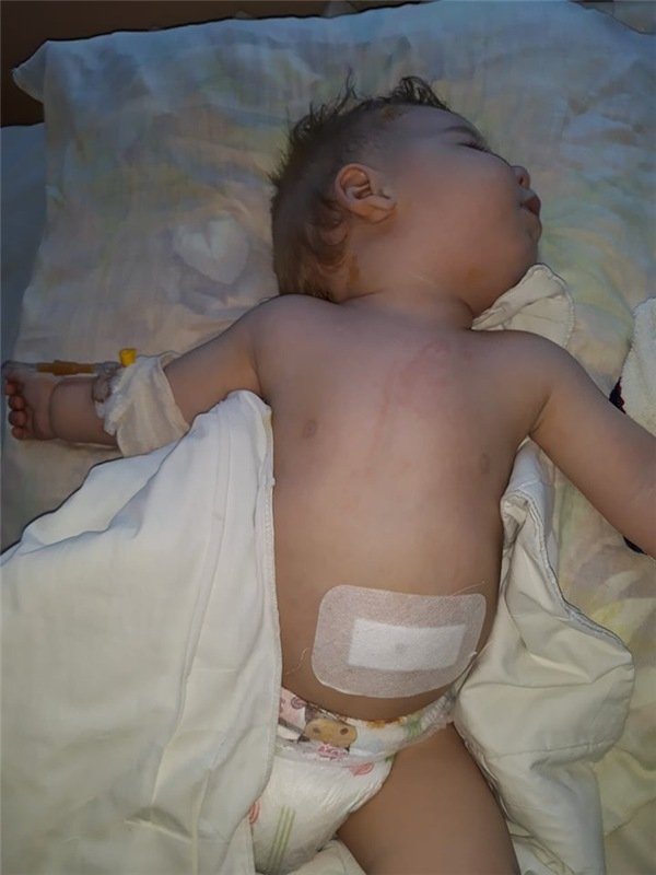 5 операцій за 11 місяців життя: малюк, хворий на гідроцефалію, потребує допомоги