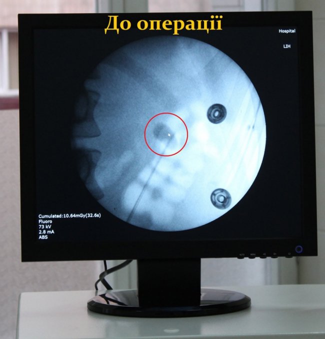 На Волині камені з нирок  лікарі видаляють за новим  методом