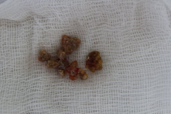 На Волині камені з нирок  лікарі видаляють за новим  методом