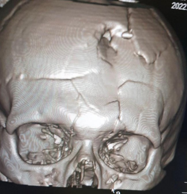 Куля влучила в голову: у лікарні Мечникова рятують чоловіка зі смертельним пораненням 