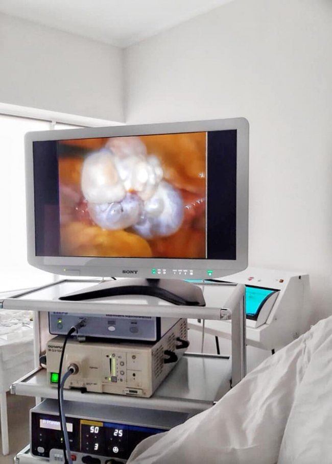 Волинські лікарі видалили кісту у жінки і позбавили її постійного болю