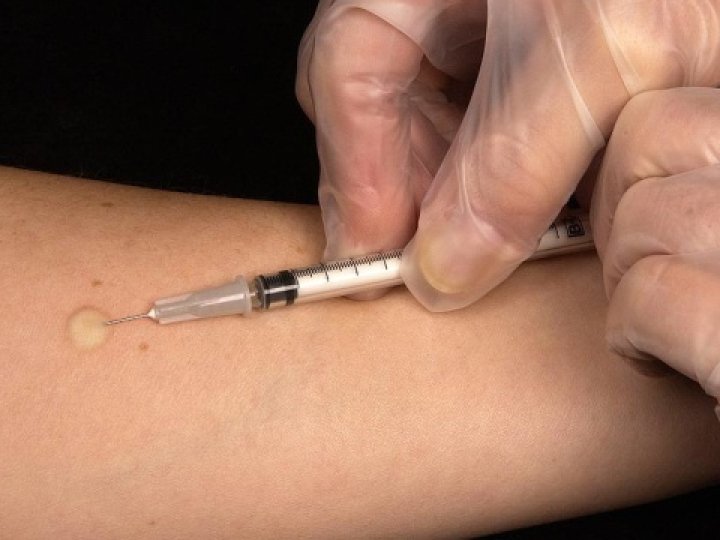 Замість проби Манту: з квітня Україна переходить на нові методи виявлення туберкульозу