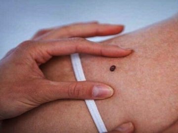 У місті на Волині під час безкоштовної перевірки у двох людей виявили рак шкіри 