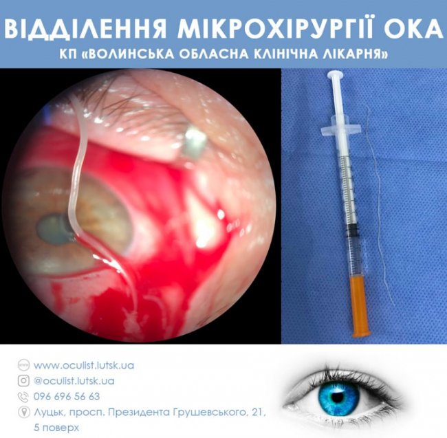 Волинські лікарі витягли з ока пацієнта гельмінта довжиною більше 12 сантиметрів