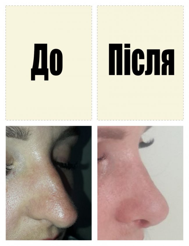 (Не)безпечна краса: лучанка судитиметься із пластичним хірургом. ОНОВЛЕНО