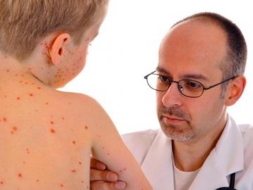 У Луцьку за останній тиждень вдвічі зменшилась кількість хворих на кір