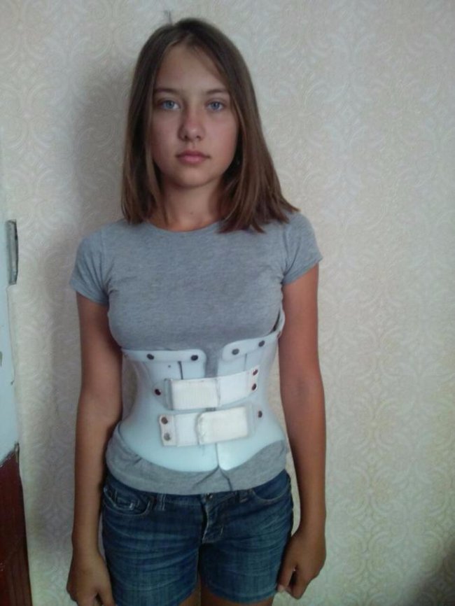 Волинянці просять допомогти назбирати на лікувальний корсет