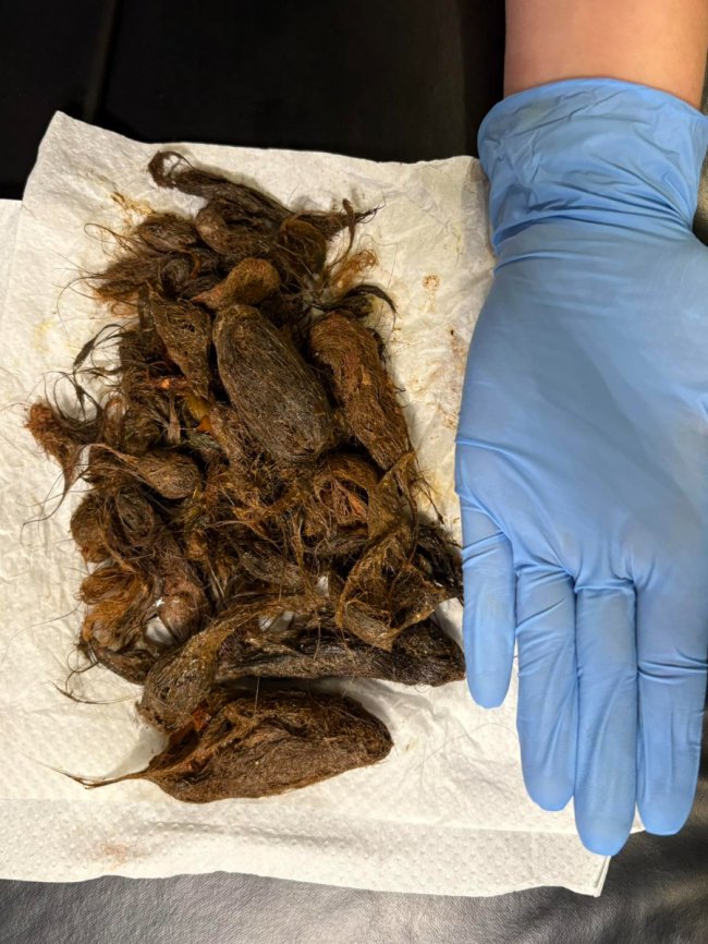 Волосся заповнило третину шлунка: у Луцьку лікарі врятували 7-річну дівчинку