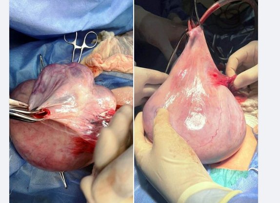 На Волині дівчинці-підлітку видалили гінекологічну пухлину великих розмірів. ФОТО 18+