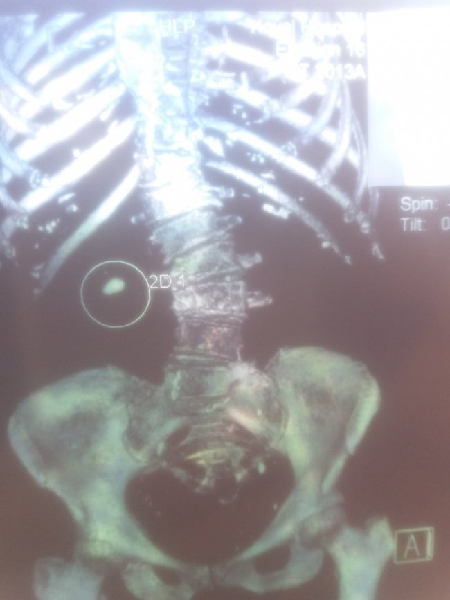 У волинській лікарні пацієнту видалили величезний камінь з нирки. ФОТО