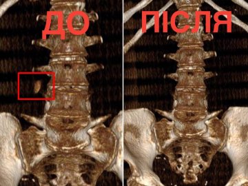 Волинські медики видалили жінці камінь без жодного надрізу