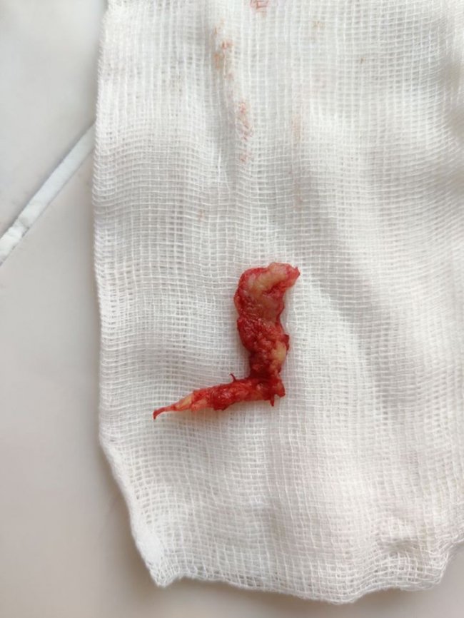 Волинські лікарі врятували життя чоловіку, у якого виявили грижу