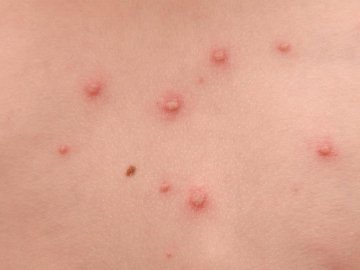 Відомий лікар спростував поширені міфи про мавпячу віспу