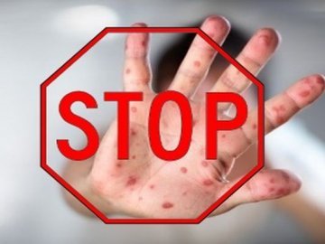 Волинь входить в топ-5 областей за рівнем захворюваності на кір