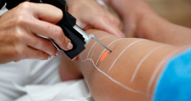 Види лазерів для виведення татуювань*