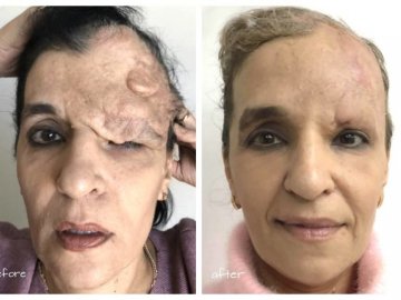 Відомий хірург з Волині врятував жінці обличчя після складної хвороби. ФОТО