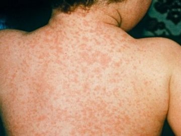 На Волині щодня фіксують від 20 до 40 хворих на кір