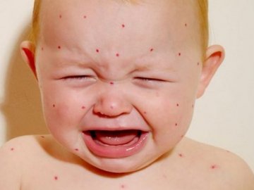 У місті на Волині – спалах кору