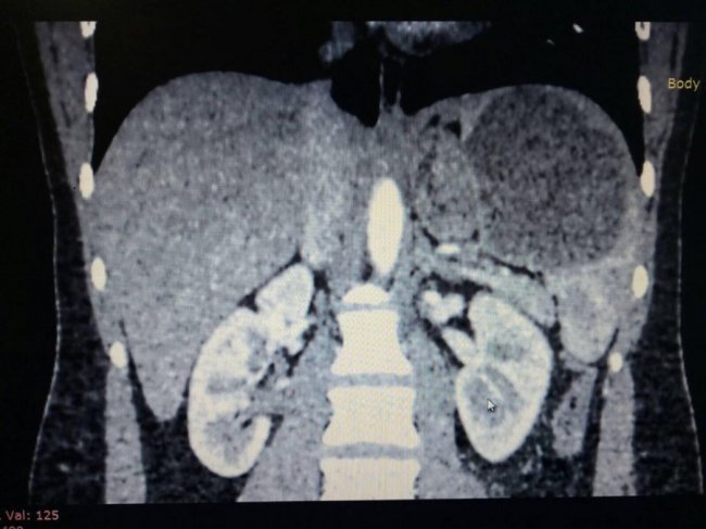 Вперше у луцькій лікарні 21-річній дівчині видалили хвору селезінку без розрізу 