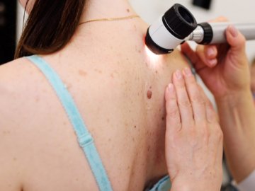 У селі поблизу Луцька охочих безкоштовно обстежуватимуть на рак шкіри