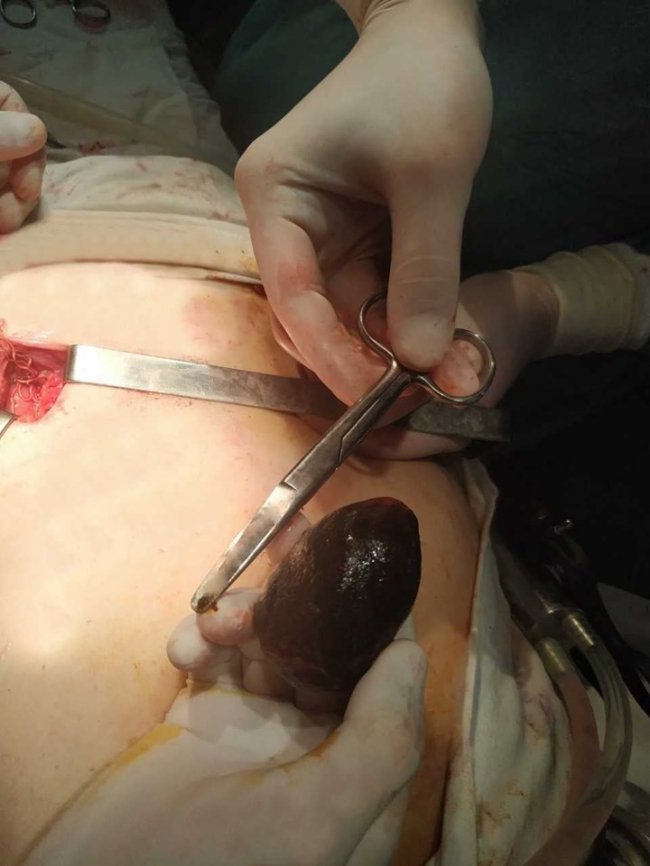 Волинські хірурги видалили величезний камінь з нирки пацієнта. ФОТО