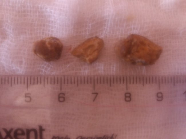 У волинській лікарні пацієнту видалили величезний камінь з нирки. ФОТО