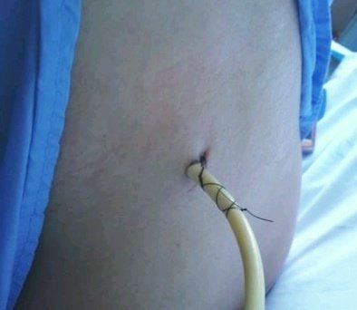 У волинській лікарні пацієнту видалили величезний камінь з нирки. ФОТО