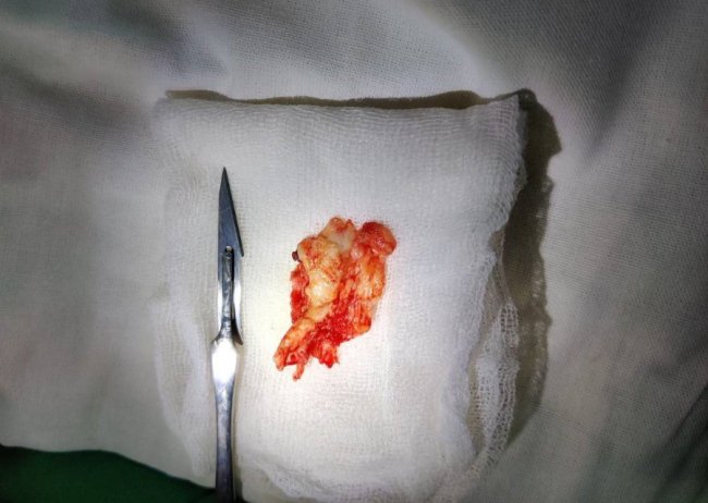 Була загроза втрати функцій ноги: у Ковелі лікарі видалили чоловікові величезну міжхребцеву грижу