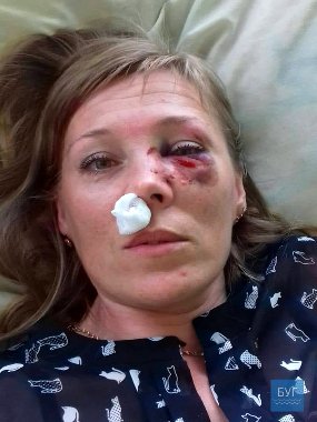 «Аліментів захотіла?» - на Волині чоловік побив колишню дружину. ФОТО. ВІДЕО. 18+