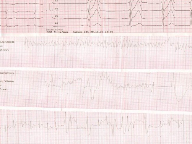 На Волині медики повернули до життя чоловіка після зупинки серця