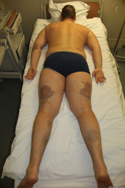 Відрізане вухо, проколи на руках, ‒ катування Булатова. ФОТО