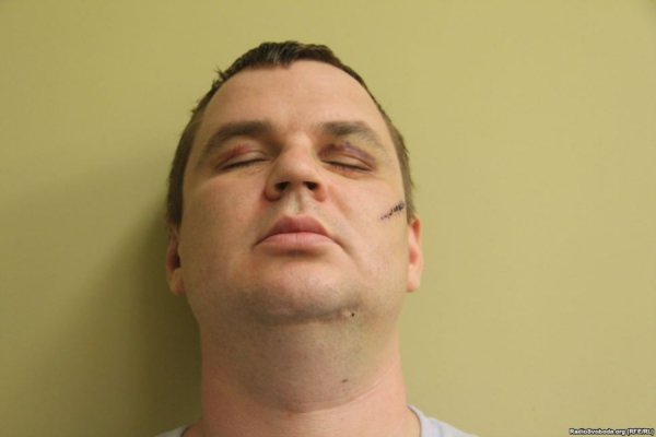 Відрізане вухо, проколи на руках, ‒ катування Булатова. ФОТО