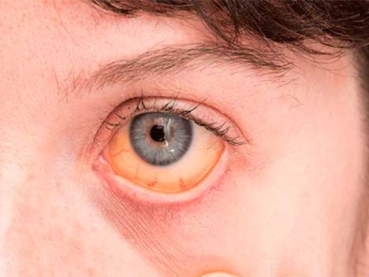 На Волині виявили вірусний гепатит А: що треба знати про захворювання