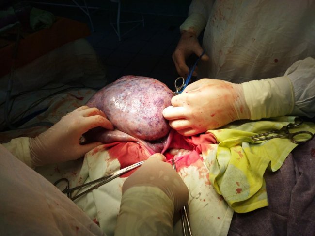 Луцькі лікарі видалили у жінки величезну пухлину, у якій було 4 л рідини.ФОТО18+