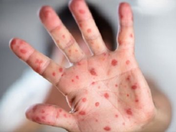 Луцька студентка привезла у село кір