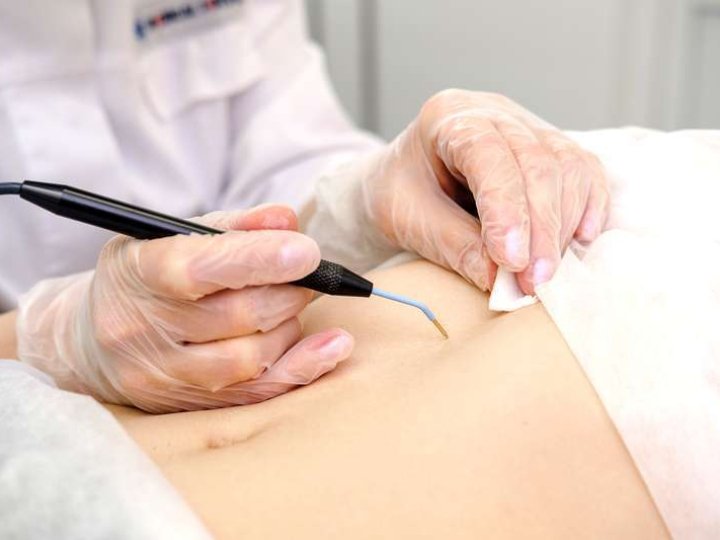 Ефективне та безпечне видалення бородавок у Києві