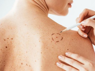 Жителів Нововолинська безкоштовно перевірятимуть на рак шкіри