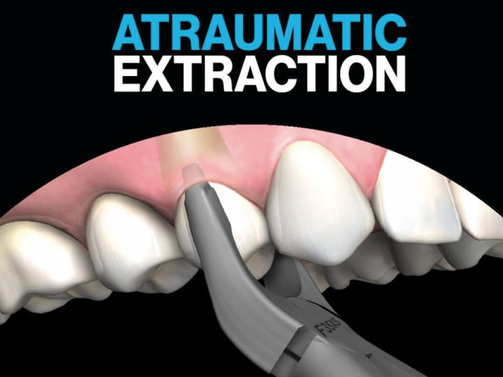 Що таке атравматичне видалення зубів