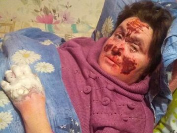 Підпалив жінку і помер від отруєння: шокуюча історія волинянина-пияка